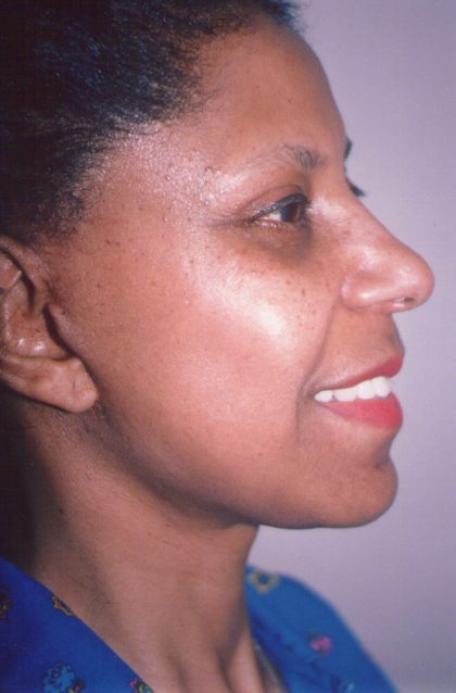 Facial Rejuvenation Before & After Patient #111