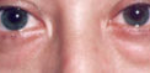 Lower Eyelids Before & After Patient #960
