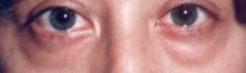 Lower Eyelids Before & After Patient #960