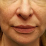 Silhouette InstaLift Before & After Patient #904