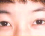 Asian Eyes Before & After Patient #998