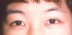 Asian Eyes Before & After Patient #998