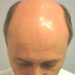 Hair Restoration & Reconstruction Before & After Patient #1025