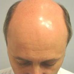 Hair Restoration & Reconstruction Before & After Patient #1025