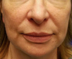Silhouette InstaLift Before & After Patient #904