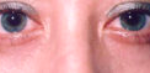 Lower Eyelids Before & After Patient #960