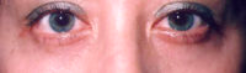Lower Eyelids Before & After Patient #960