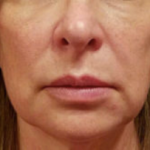 Silhouette InstaLift Before & After Patient #904