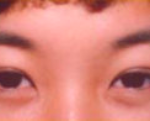 Asian Eyes Before & After Patient #998