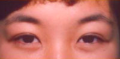 Asian Eyes Before & After Patient #998