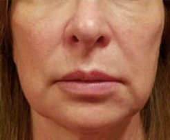 Silhouette InstaLift Before & After Patient #904