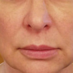 Silhouette InstaLift Before & After Patient #904