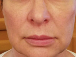 Silhouette InstaLift Before & After Patient #904