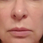 Silhouette InstaLift Before & After Patient #904
