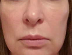 Silhouette InstaLift Before & After Patient #904