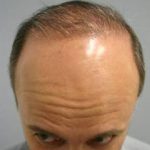 Hair Restoration & Reconstruction Before & After Patient #1025