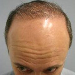 Hair Restoration & Reconstruction Before & After Patient #1025