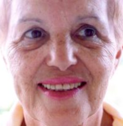 Non-Surgical Facelifts Before & After Patient #130