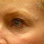Facial Rejuvenation Before & After Patient #71