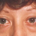 Eyelid and Brow Lift Before & After Patient #922