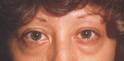 Eyelid and Brow Lift Before & After Patient #922