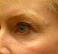 Facial Rejuvenation Before & After Patient #71