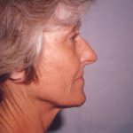 Facial Rejuvenation Before & After Patient #121