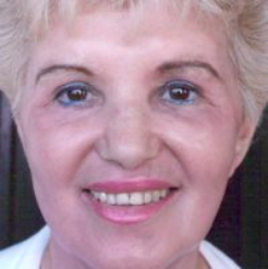 Non-Surgical Facelifts Before & After Patient #130