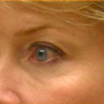 Facial Rejuvenation Before & After Patient #71