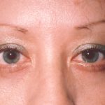 Eyelid and Brow Lift Before & After Patient #922
