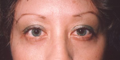 Eyelid and Brow Lift Before & After Patient #922
