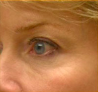 Facial Rejuvenation Before & After Patient #71