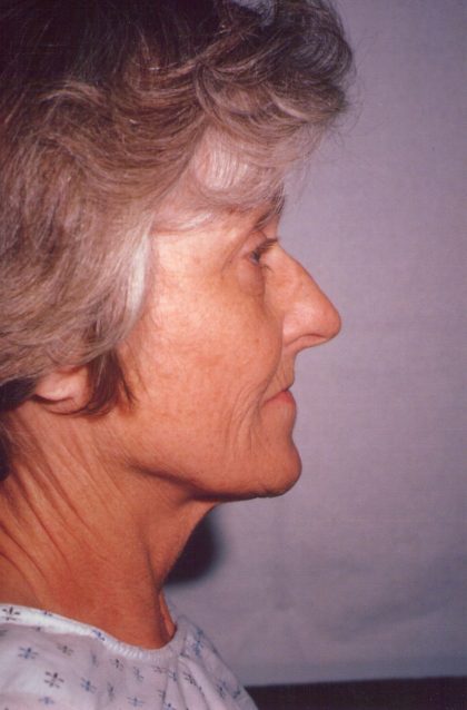 Facial Rejuvenation Before & After Patient #121