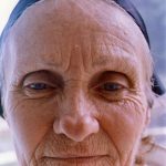 Facial Rejuvenation Before & After Patient #101