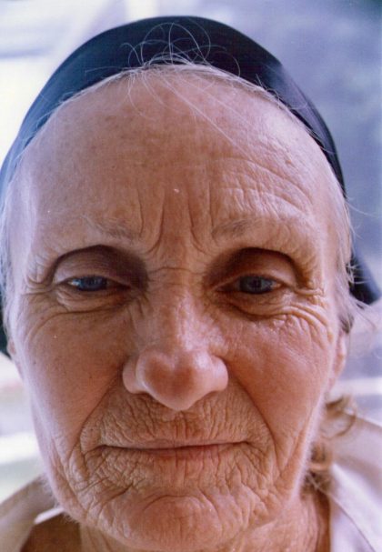 Facial Rejuvenation Before & After Patient #101
