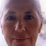 Non-Surgical Facelifts Before & After Patient #131