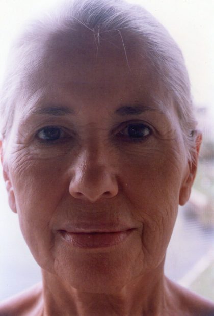 Non-Surgical Facelifts Before & After Patient #131