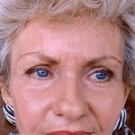 Facial Rejuvenation Before & After Patient #101