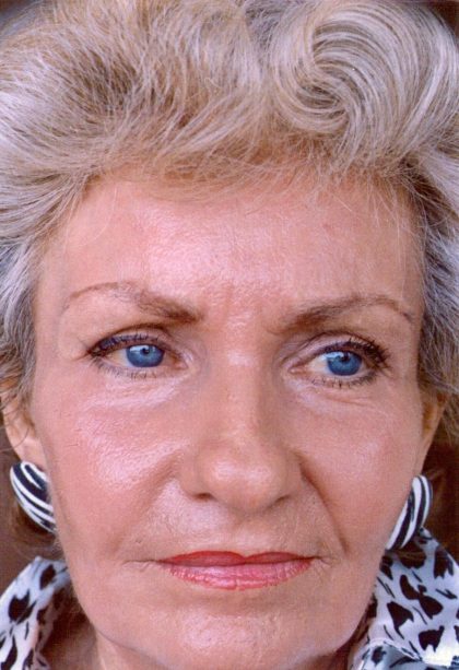 Facial Rejuvenation Before & After Patient #101