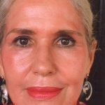 Non-Surgical Facelifts Before & After Patient #131