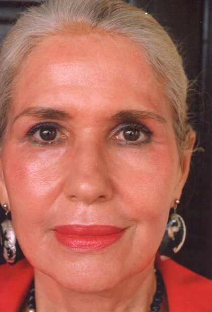 Non-Surgical Facelifts Before & After Patient #131