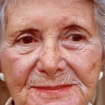 Facial Rejuvenation Before & After Patient #100