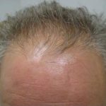Hair Restoration & Reconstruction Before & After Patient #1024