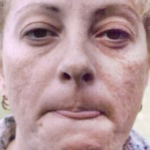 Non-Surgical Facelifts Before & After Patient #831