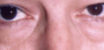 Lower Eyelids Before & After Patient #947