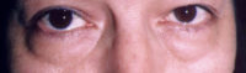 Lower Eyelids Before & After Patient #947