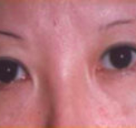 Asian Eyes Before & After Patient #980