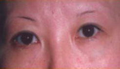 Asian Eyes Before & After Patient #980