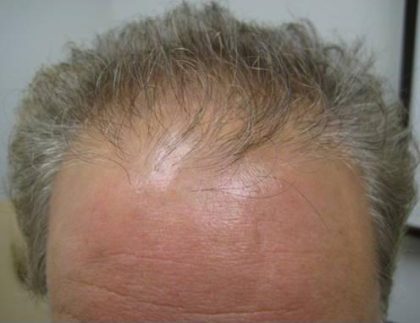 Hair Restoration & Reconstruction Before & After Patient #1024