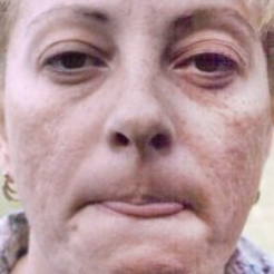 Non-Surgical Facelifts Before & After Patient #831